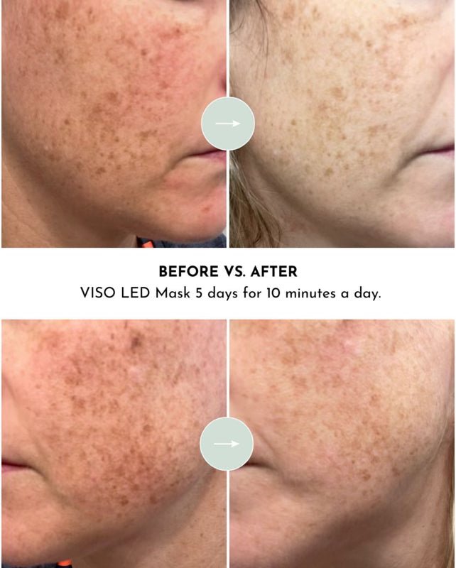 VISO - FDA Certified Red Light Therapy Mask - The Vitality Estate